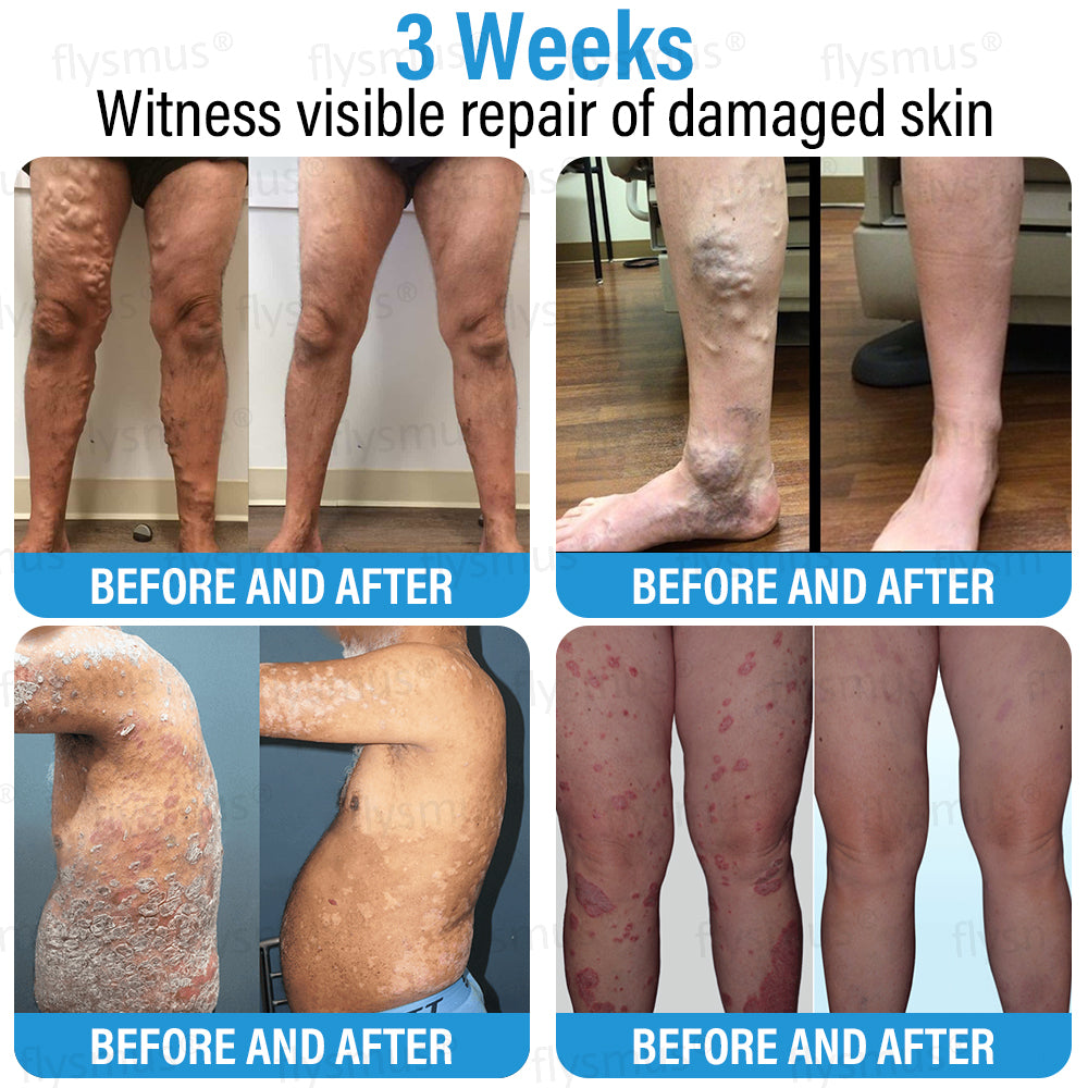 ✅ Made and Shipped from the UK | flysmus® Botox Repair Cream 🧑🏼⚕️ Anti-aging, Skin Repair, Acne and Dark Spot Treatment, Wart and Mole Removal, and Psoriasis Treatment🍀