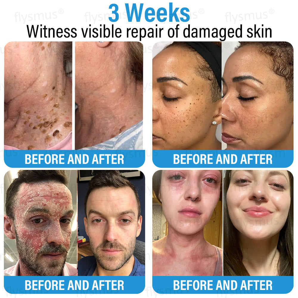 ✅ Made and Shipped from the UK | flysmus® Botox Repair Cream 🧑🏼⚕️ Anti-aging, Skin Repair, Acne and Dark Spot Treatment, Wart and Mole Removal, and Psoriasis Treatment🍀