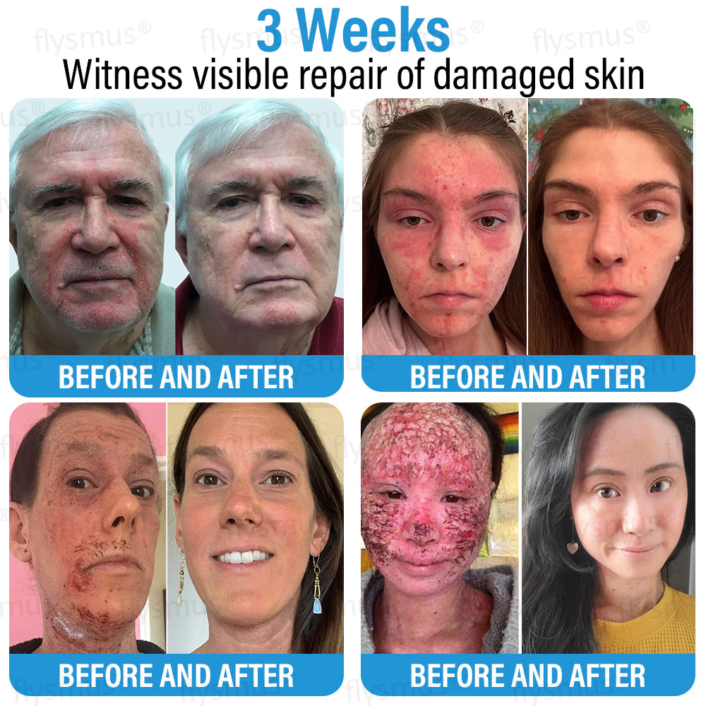 ✅ Made and Shipped from the UK | flysmus® Botox Repair Cream 🧑🏼⚕️ Anti-aging, Skin Repair, Acne and Dark Spot Treatment, Wart and Mole Removal, and Psoriasis Treatment🍀